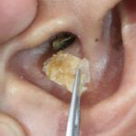 耳掃除の難聴 最大の耳垢除去 | #T7H35