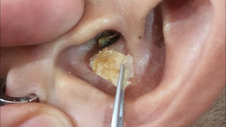耳掃除の難聴 最大の耳垢除去 | #T7H35