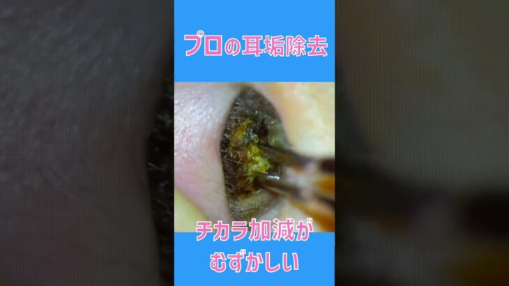 耳そうじ   セッシと吸引　#shorts